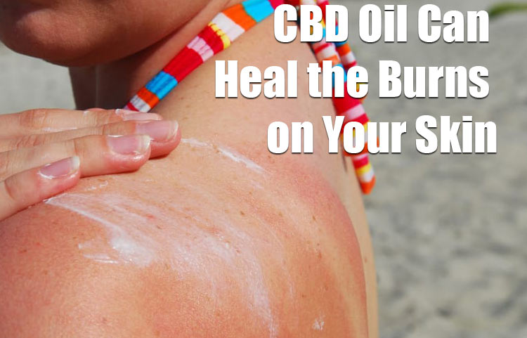CBD Oil Can Heal Skin Burns Faster